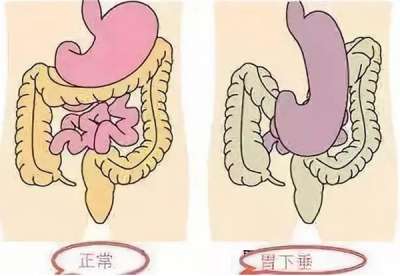 胃下垂吃什么中成藥?